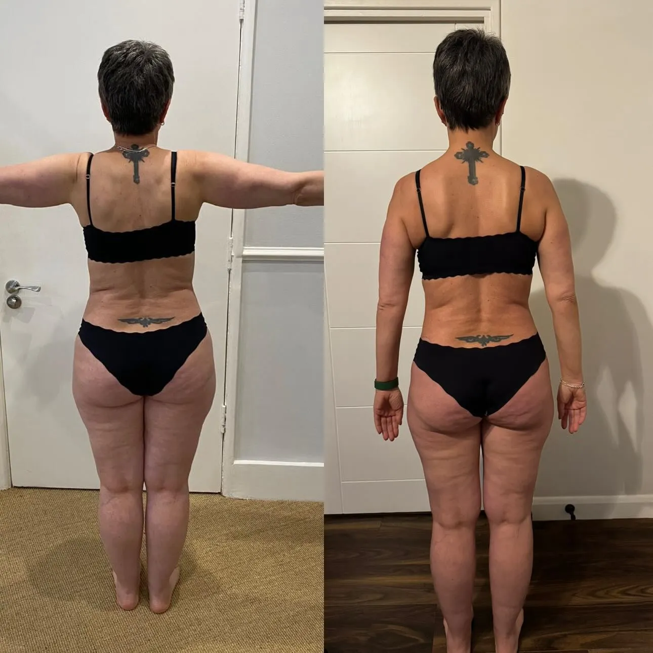 Resultado antes e depois de Giancarla — 8,6kg perdidos com o Protocolo de Chás para Lipedema