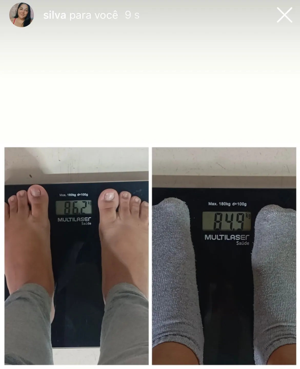 Resultado de Sil — 1,3kg em menos de 15 dias com o Protocolo de Chás para Lipedema